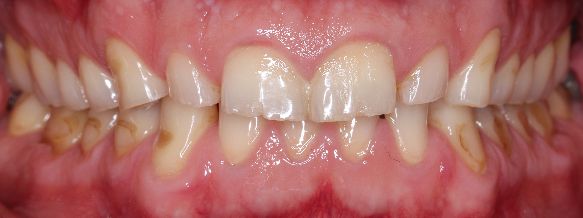 Abgeknirschte Frontzähne