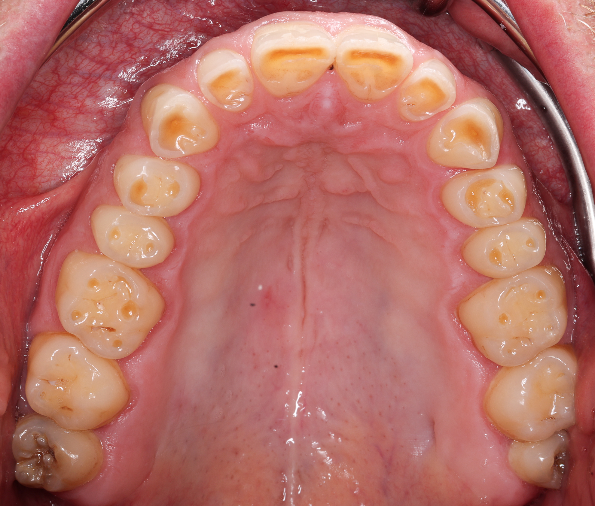 Durch Knirschen zerstörte Zähne im Oberkiefer in Draufsicht