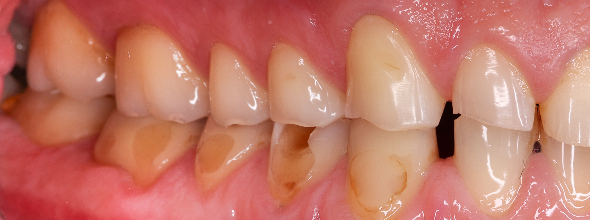 Durch Bruxismus zerstörte Seitenzähne