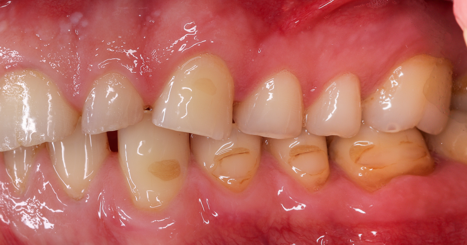 Durch Bruxismus zerstörte Seitenzähne