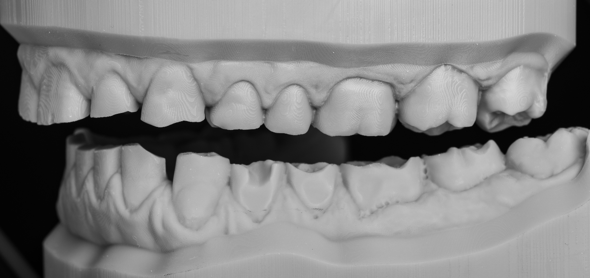 zerstörte Seitenzähne links