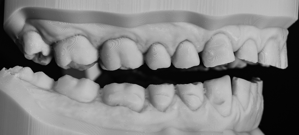 zerstörte Seitenzähne rechts