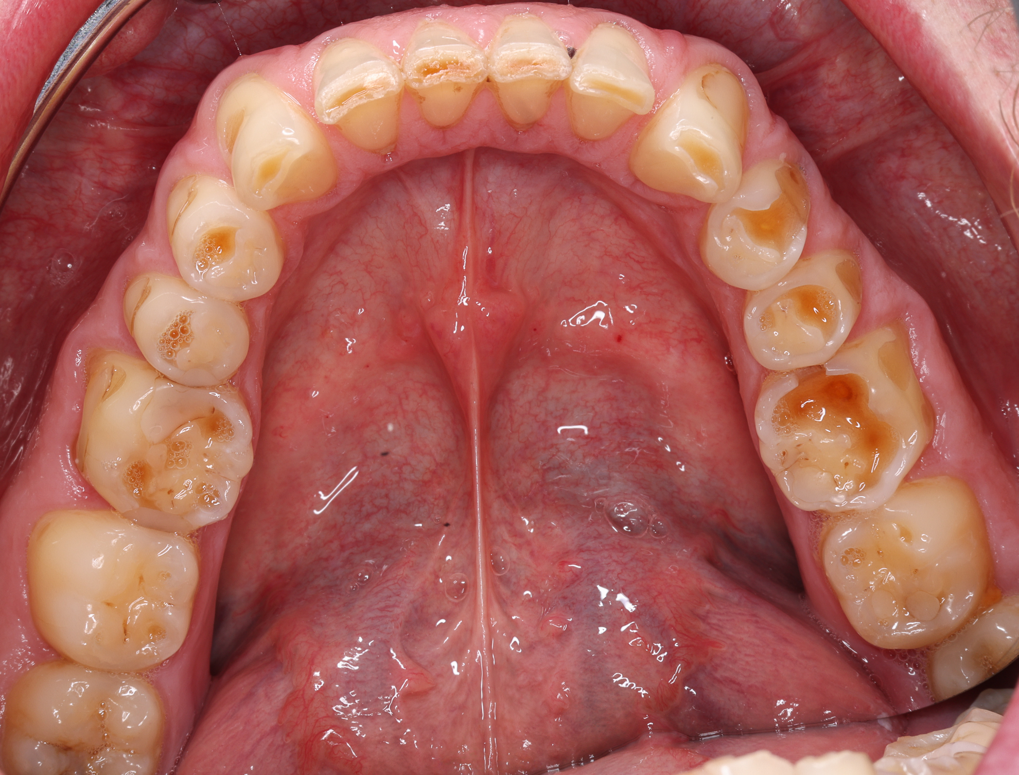 Durch Knirschen zerstörte Zähne im Unterkiefer in Draufsicht