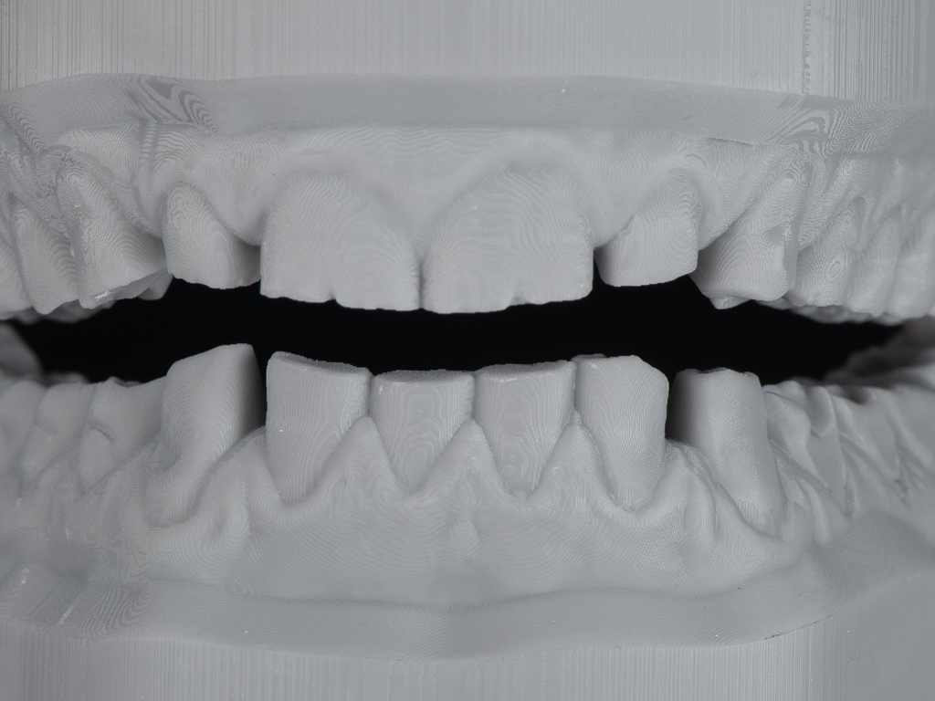 durch Knirschen zerstörtes Gebiss