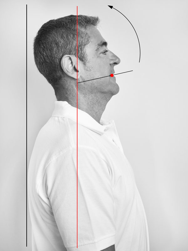 Foto einer Frontzahn Gebisssituation