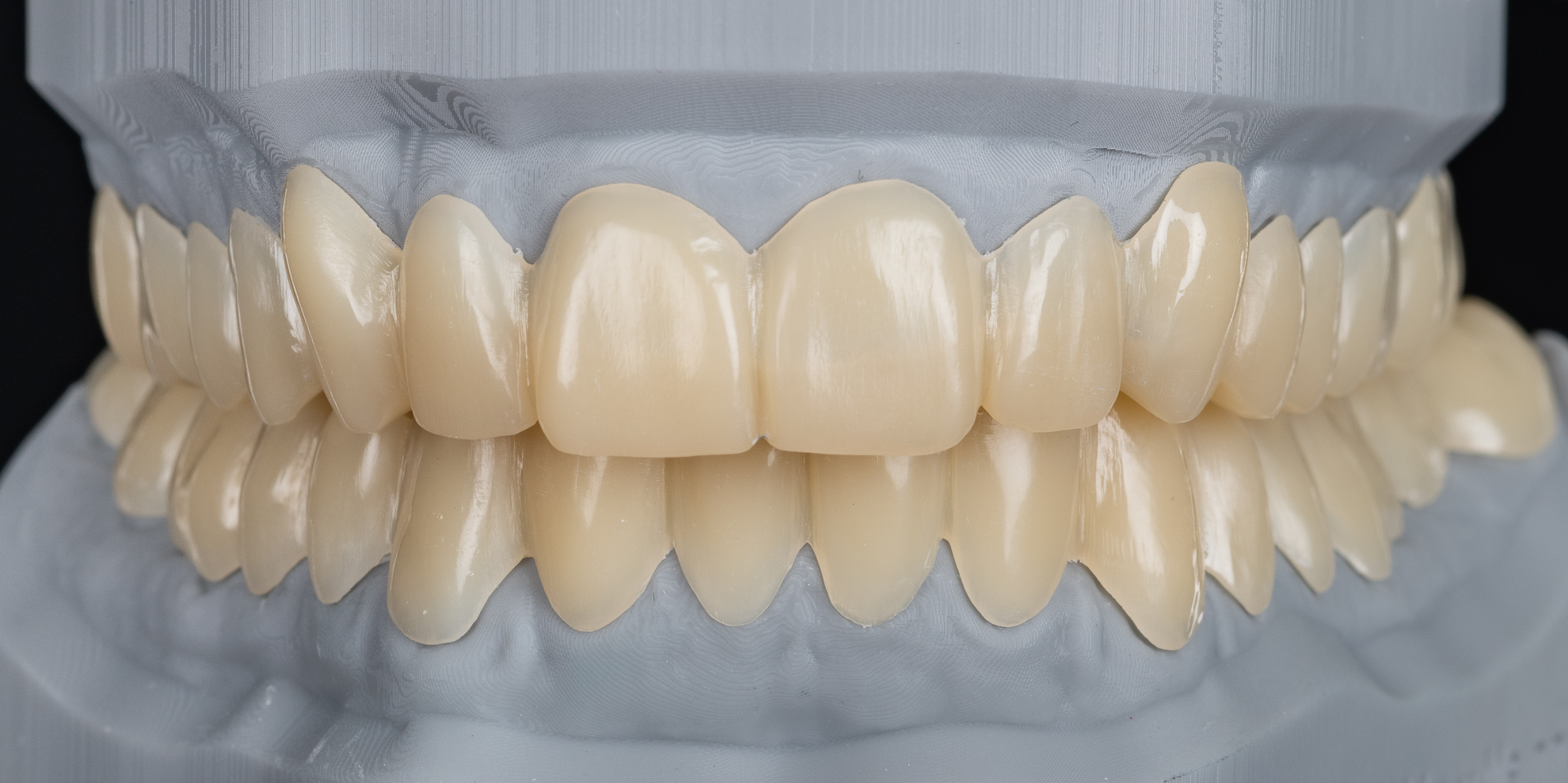 Polycarbonnatschienen für Ober- und Unterkiefer