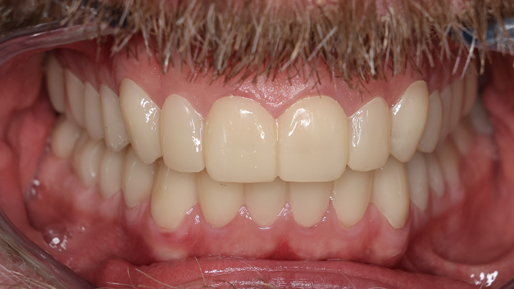 beide Polycarbonatschienen im Mund