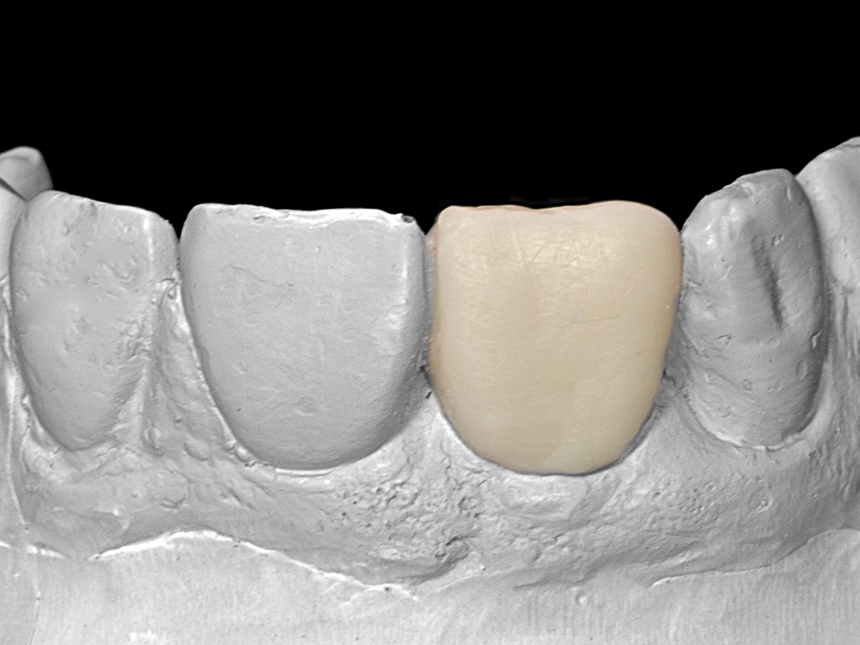 Wax-up für ein Implantat