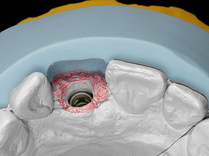 Implantatdurchtritt am Modell planen