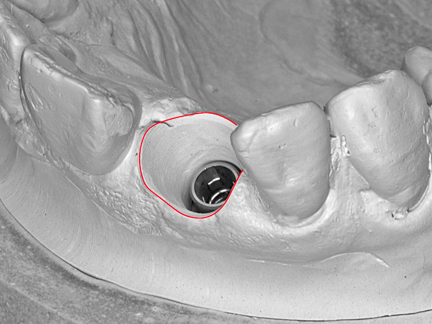 Implantatdurchtritt am Modell vorbereitet