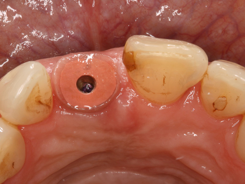 Zahnfleisch nach der Ausfprmung mittels Gingivaformer