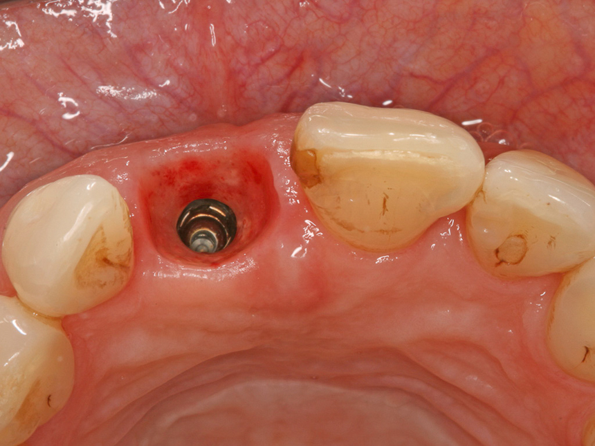 individuelles Implantatabutment