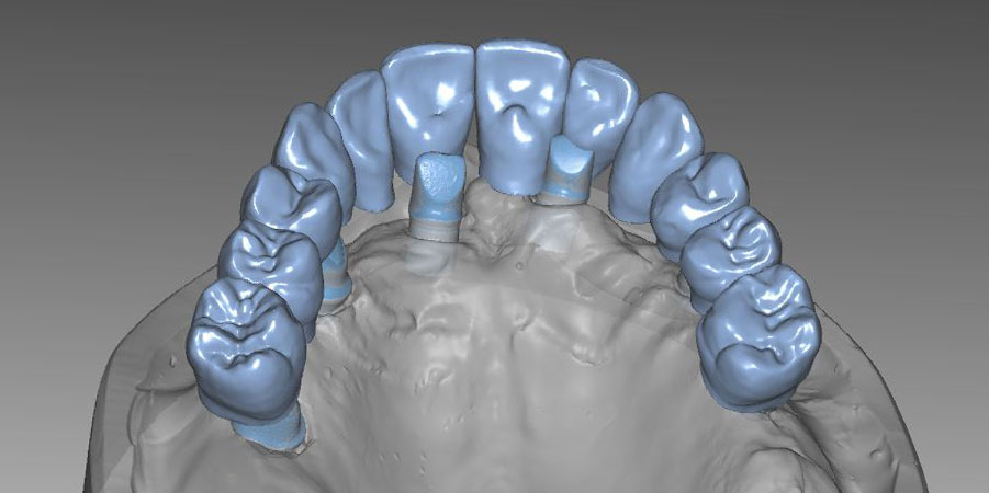 CAD Planung für Implantatbrücke