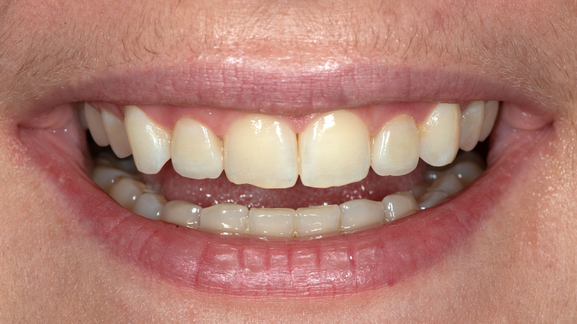 2 Zapfenzähne mit Non-Präp Veneers versorg