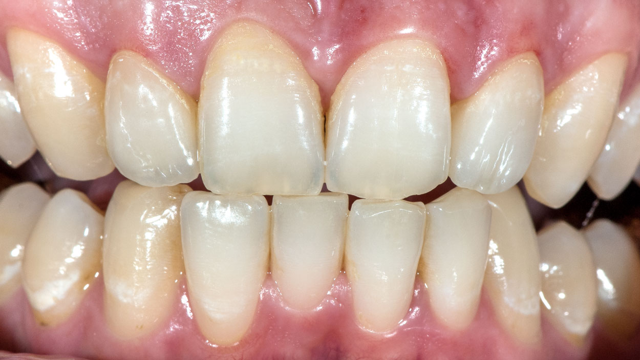 2 Zapfenzähne mit Non-Präp Veneers versorgt