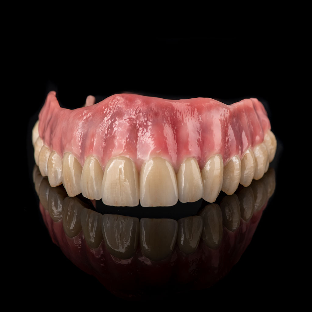 individualierte Implnataatprothese - Zähne und Zahnfleisch